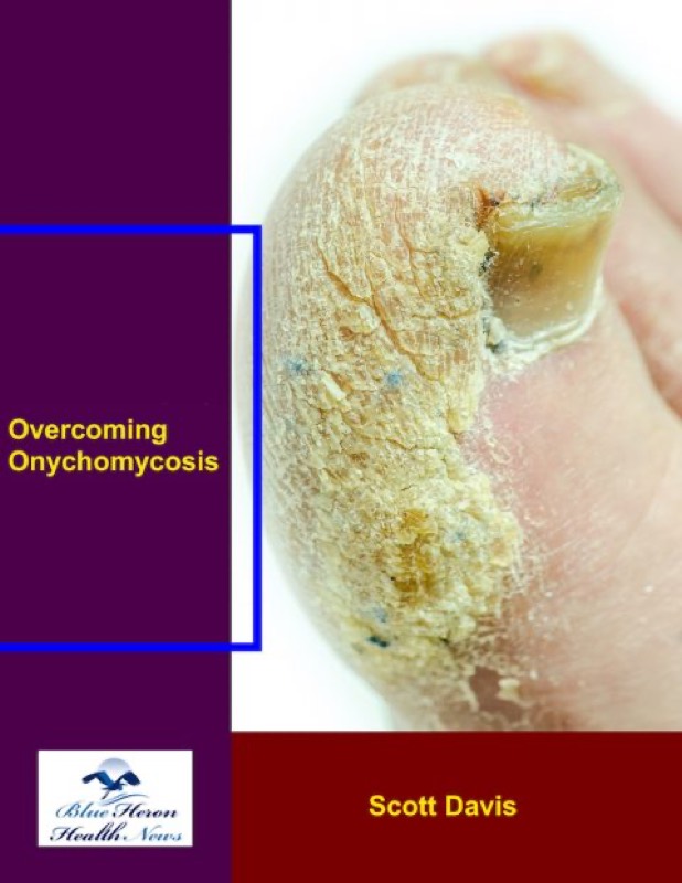Overcoming Onychomycosis - Nail Fungus vendor product image for the Everyrated review